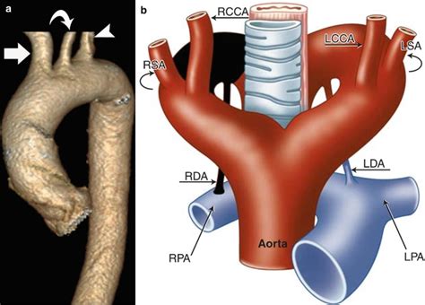 Aortic Arch Abnormalities