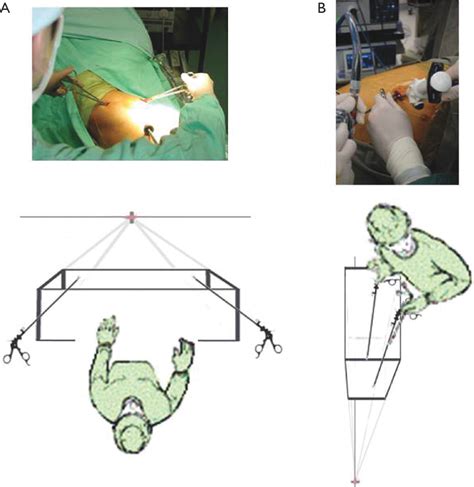 Figure From The Evolution Of Minimally Invasive Thoracic Surgery