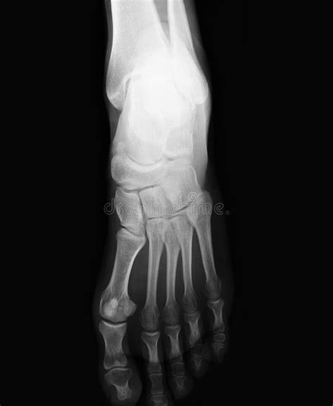 Foot Xray Showing Soft Tissue Gas In Patient With Necrotizing