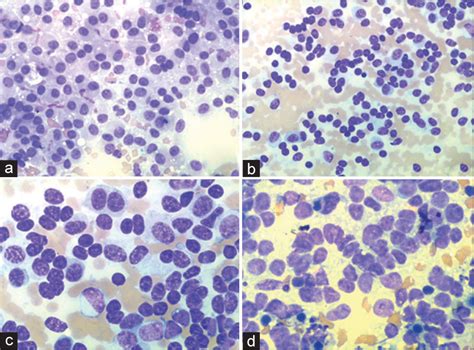 Grading Of Pancreatic Neuroendocrine Tumors On Endoscopic Ultrasound Guided Fine Needle