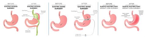 Choosing A Procedure Arch Bariatrics