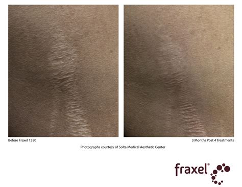 Fraxel Laser Treatment Cost Results Studiomd Midtown Manhattan Nyc