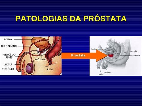 A Patologia Da Prostata