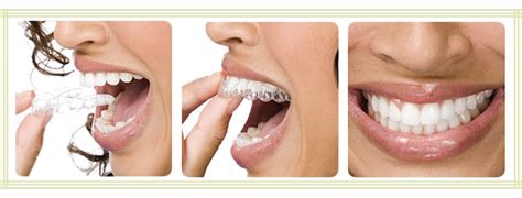 Aligners Clear Correct Invisible Braces Frisco Wildflower Dental