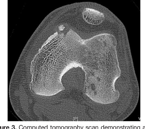 Figure From Arthroscopic Visualization And Assisted Excision Of