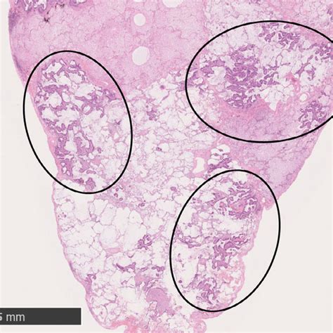 Surgical Lung Biopsy Specimen Histologically The Specimen Showed