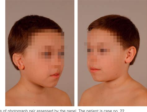 Figure 1 From The Learning Curve In Microtia Surgery Semantic Scholar