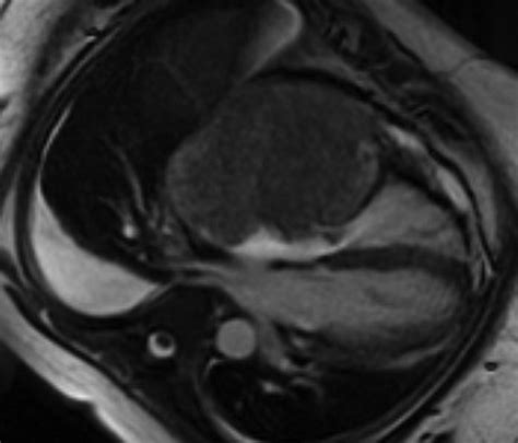 Ajr Teaching File Right Atrial Mass In A Woman With Dyspnea On