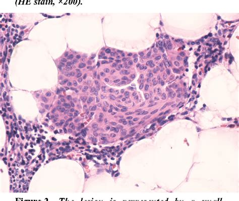 Figure 2 from A nodular hyperplasia of the thymic epithelium (so-called microscopic thymoma ...