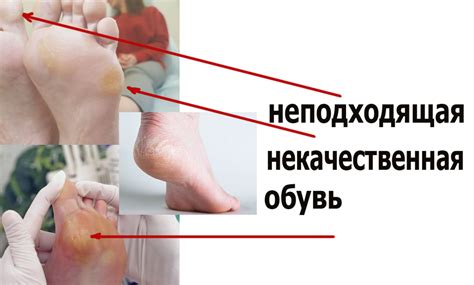 Этиология натоптышей на стопе - быстрый путь к здоровью ног. | Сам Себе ...