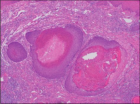 Multiple Masses Within Dermis Eosinophilic Ghost Cells Can Be Seen In