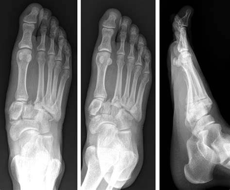 Lisfranc Fracture Dislocation