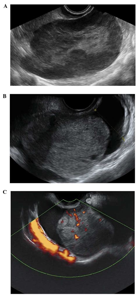 Ovarian Mass Ultrasound