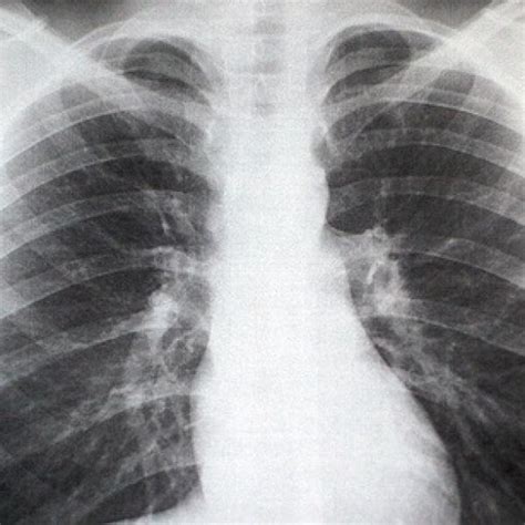 Fisura De Costilla Tiempo De Recuperación Hot Sale varsana