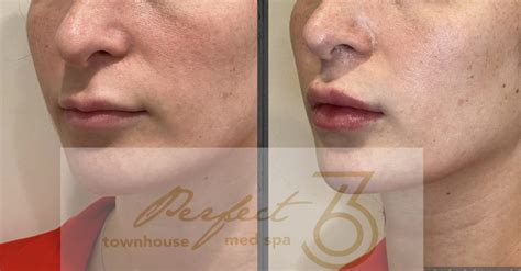 Liplase Laser Lips Treatment Perfect Medspa Store Body Skin Care