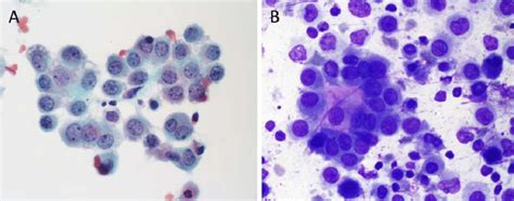 Tumor Cells In Pleural Fluid