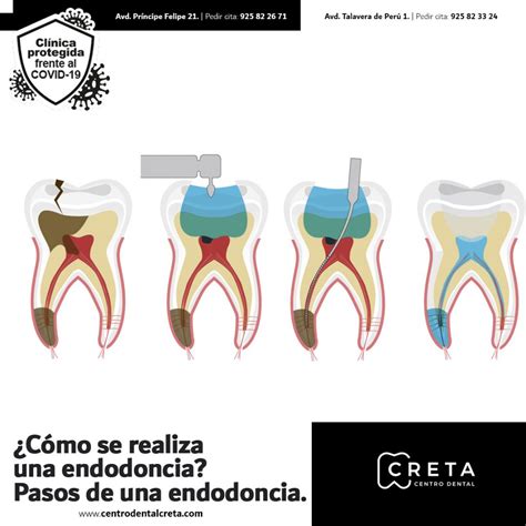 Cómo se realiza una endodoncia Pasos de una endodoncia