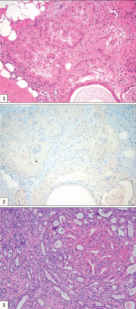 Figure From Atypical Apocrine Adenosis Diagnostic Challenges And