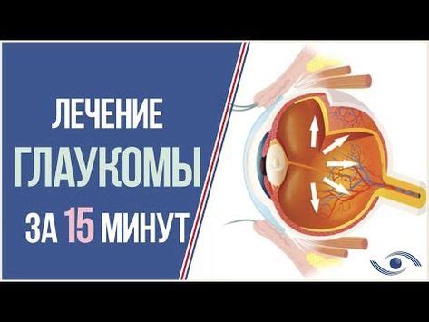 Глаукома. Как лечить? Лечение глаукомы в Новосибирске за 15 мин ...