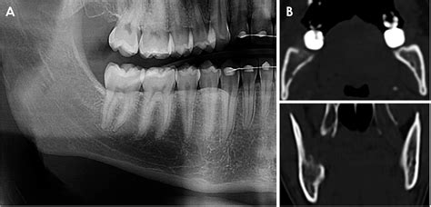 PDF A Rare Case Of Ewing Sarcoma Metastasis To The Oral Cavity