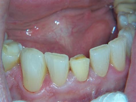 Dental Pulp Calcification Spelunking In The Dentin Bite Point