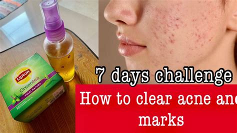 How To Remove Pimples On Face How To Clear Acne And Acne Marks On