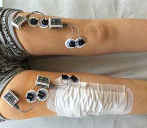 The Use Of Surface Electromyography In Rehabilitating Rheumatic