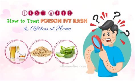 Top 10 Fast Ways How To Treat Poison Ivy Rash And Blisters At Home