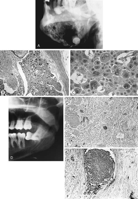 Odontogenic Tumors Surgical Pathology And Management Pocket Dentistry