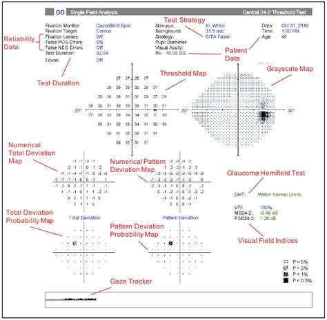 Back to Basics: Visual Field Interpretation