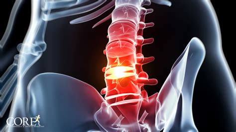 5 Unexpected Symptoms of a Herniated Disc