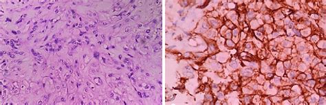 Pleural Biopsy Specimen A Hematoxylin And Eosin Staining Exhibited A