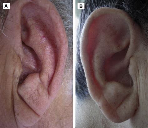 Earlobe Crease Shapes and Cardiovascular Events | Thoracic Key