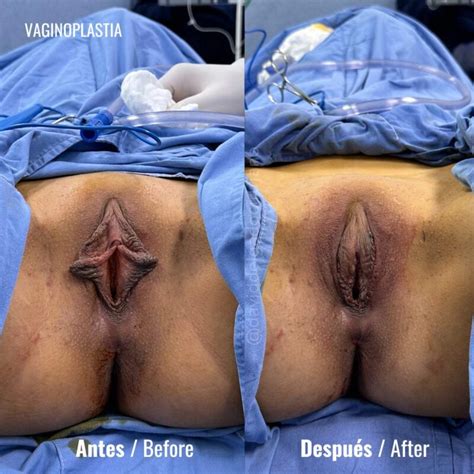 Cirug A Pl Stica Vaginal Dr David Delgado