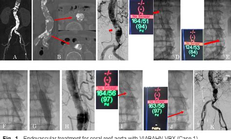 Figure From Treatment Of Coral Reef Aorta By Endovascular Viabahn Vbx