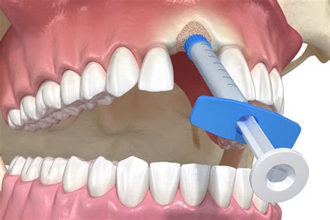 Do I Need Bone Grafting Before A Dental Implant Treatment Nova Perio