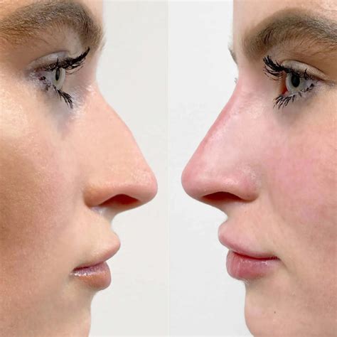 Nosefix Filler Beautyfix Medspa 212 366 4787