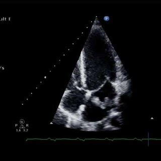 Apical four chamber view. The tumour is fully retracted into the left ...