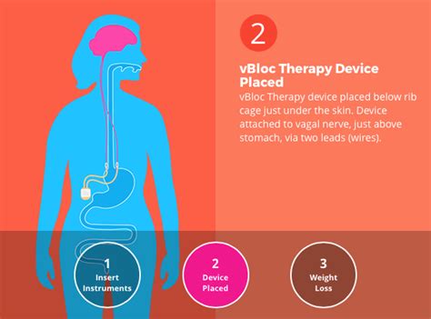 Vbloc Therapy 14 Ways It Will Affect You Bariatric Surgery Source