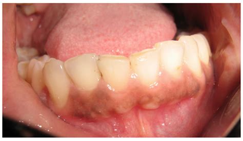 Ibima Publishing Gingival Fibrous Nodules Report Of Four Cases