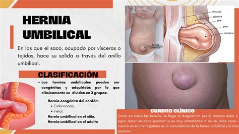 Traumatismo Abdominal Hernias Abdominales Pdf