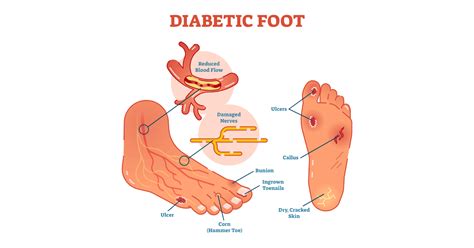 diabetic foot symptoms  prevention  treatments