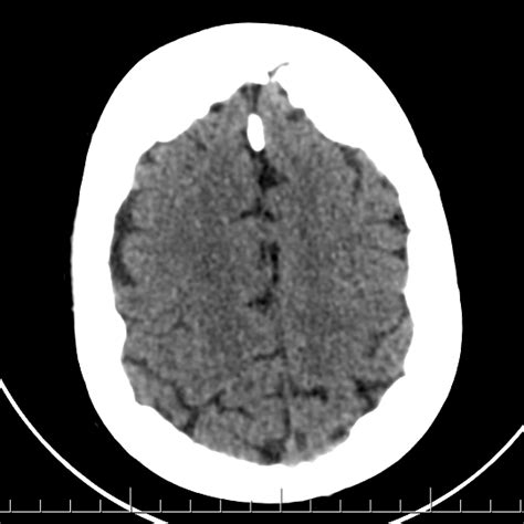 Hyperostosis Frontalis Interna