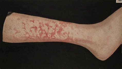 Erythema Marginatum Wikiwand