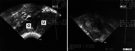 The B Mode Findings Related To The Presence Of Pelvic Adhesions