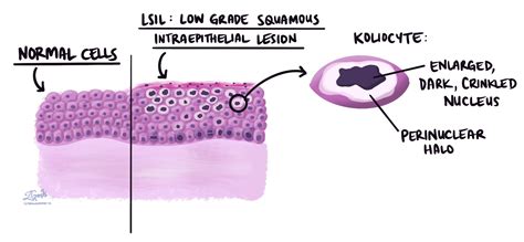 Your Pathology Report For Low Grade Squamous Intraepithelial Lesion Of The Anal Canal