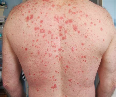 Pityriasis Rubra Pilaris Dermnet