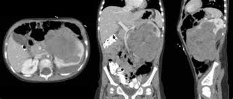 Peds Exam Gu Renal Flashcards Quizlet