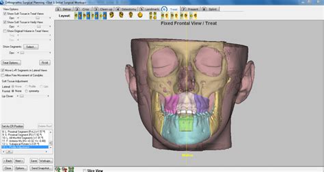 D Planning In Orthognatic Surgery Instituto Maxilofacial