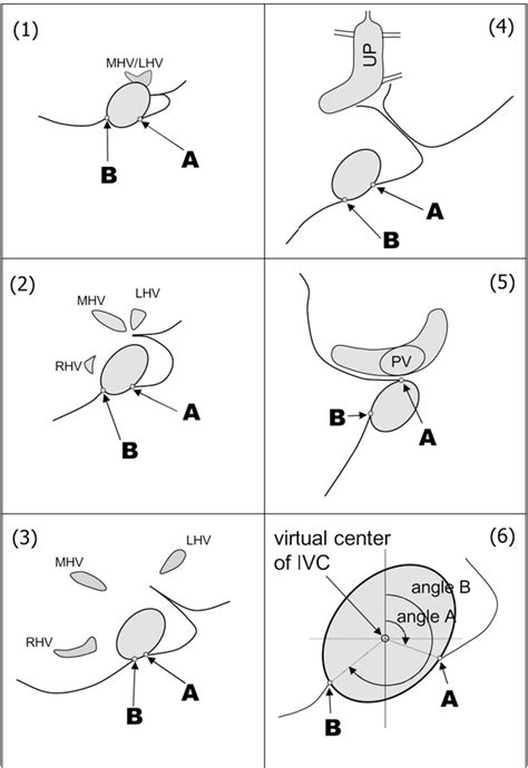 Figure 1 From Right Sided Retrocaval Approach Using Guidance Via The